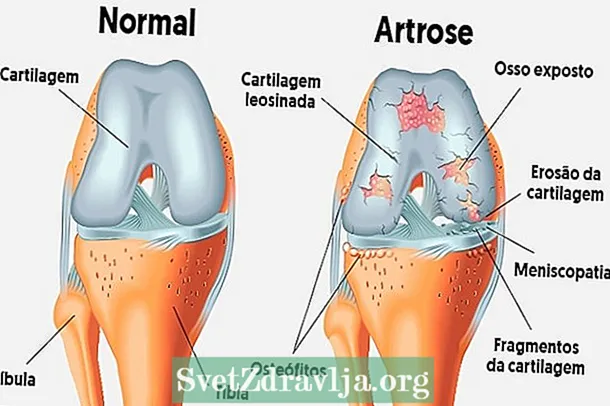 És curable l’artrosi?