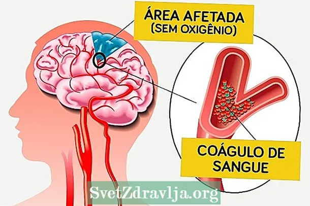 Ischemic stroke: ndi chiyani, chimayambitsa, zizindikiro ndi chithandizo