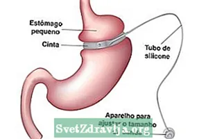 Bandă gastrică pentru a slăbi