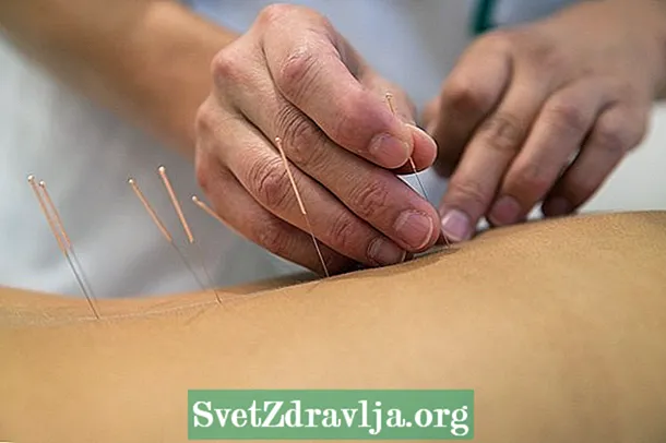Sundhedsmæssige fordele ved akupunktur