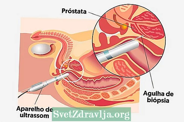 Prostatabiopsie: wéini et gemaach gëtt, wéi et gemaach a preparéiert gëtt - Fitness