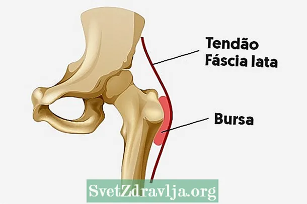 Borsite dell'anca: cos'è, principali sintomi e trattamento