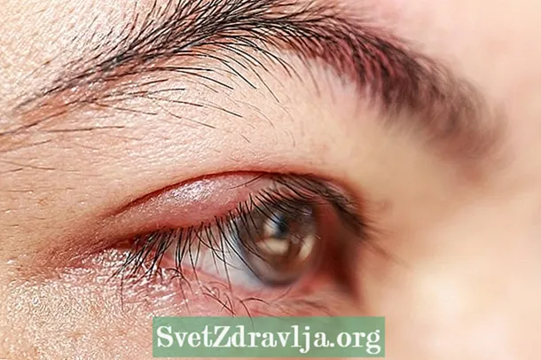 Chalazion në sy: çfarë është, simptomat kryesore dhe trajtimi