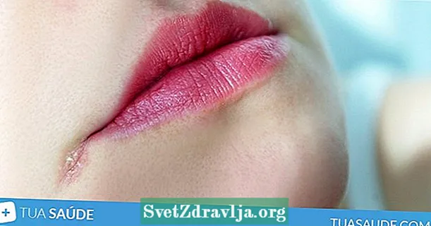 Causas y cómo tratar la boquilla (dolor en la comisura de la boca)