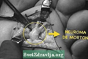 Cirurxía de neurona de Morton