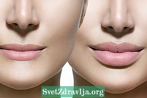 Plastična kirurgija u ustima može povećati ili smanjiti usne