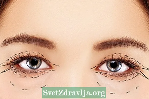 Ang plastic surgery sa mga eyelids ay nagpapabata at tumitingala