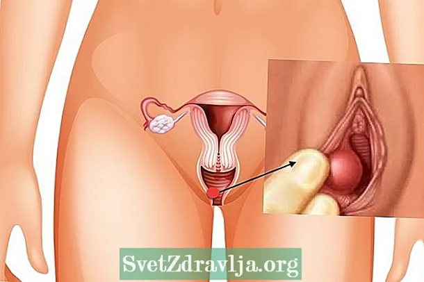 Gartner cyst: menene, alamu da magani