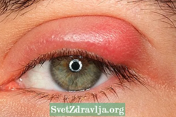 目の嚢胞：4つの主な原因と何をすべきか