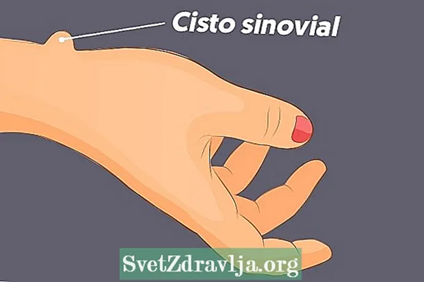 Sinovialna cista: kaj je to, simptomi in zdravljenje