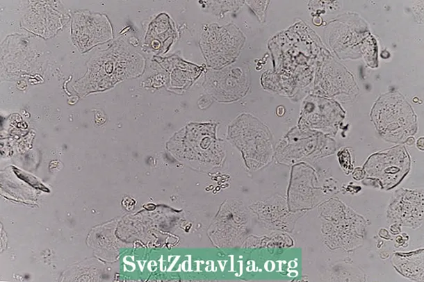 Епителне ћелије у урину: шта то може бити и како разумети тест