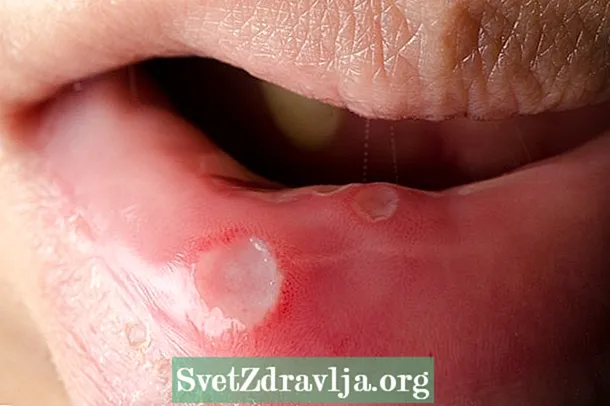 口腔癌：它是什么，症状，病因和治疗