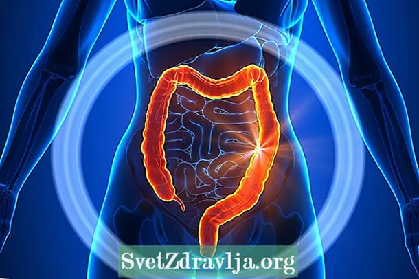Rak debelog crijeva: što je to, simptomi i liječenje