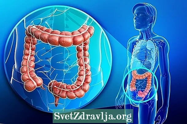 腸がん：それが何であるかと主な症状
