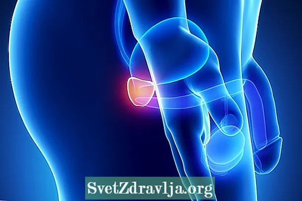 Prostata saratoni: bu nima, simptomlari, sabablari va davolash usuli