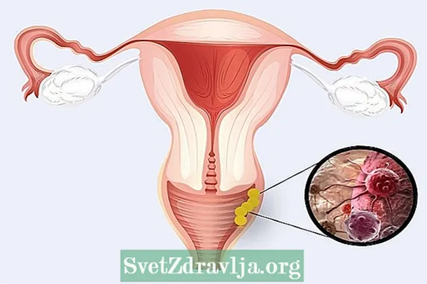 Kanker yn 'e fagina: 8 haadsymptomen, oarsaken en behanneling