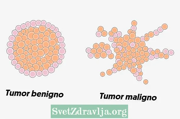 ¿Son o mesmo o cancro, a neoplasia e o tumor?