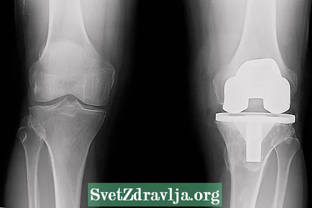 Bagaimana pembedahan prostesis lutut