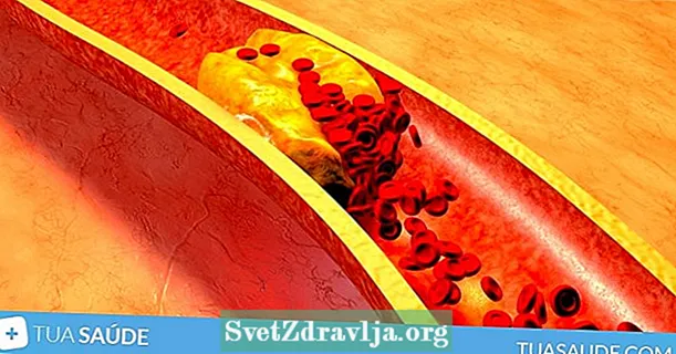 Esi wedata cholesterol ọjọọ (LDL)