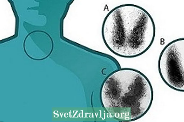 Yuav ua li cas cov thyroid scintigraphy tiav - Noj Qab Haus Huv