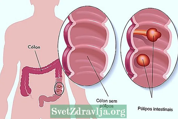 Com s’eliminen els pòlips intestinals - Aptitud