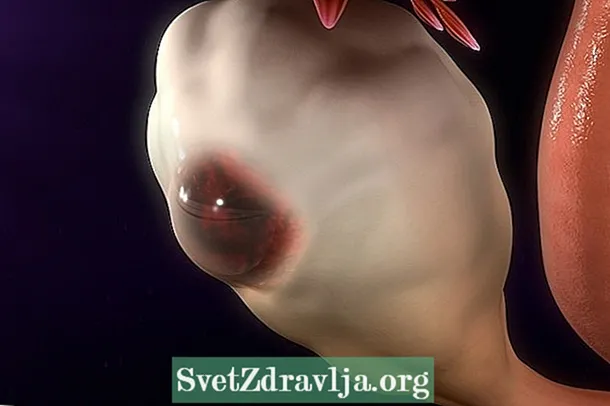 Kumusta ang pagtambal sa ovarian cyst