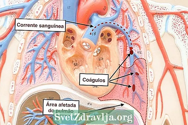 Como é o tratamento da embolia pulmonar