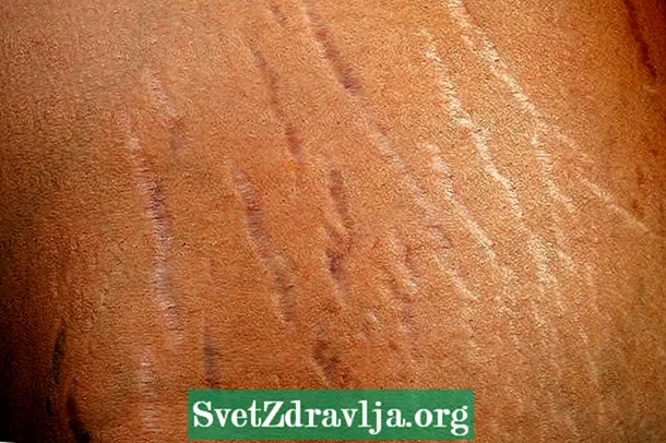 Carboxitherapy hoạt động như thế nào đối với các vết rạn da và kết quả