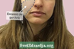 Hoe operaties voor het verscherpen van het gezicht werken
