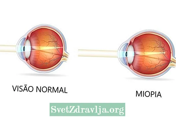 Jak identifikovat krátkozrakost a co dělat při léčbě