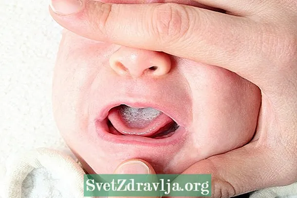 赤ちゃんのツグミを識別して治療する方法