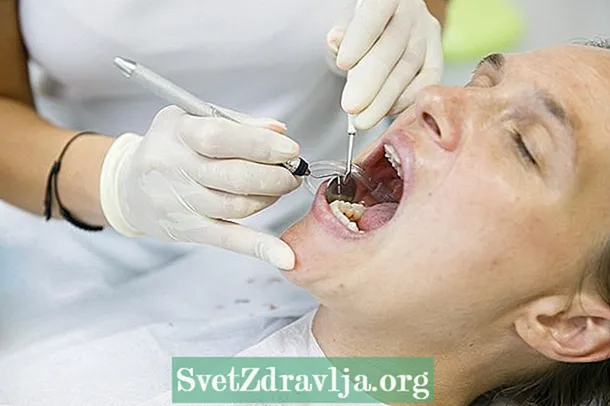 Jak identifikovat a zabránit zubnímu kamene - Zdatnost