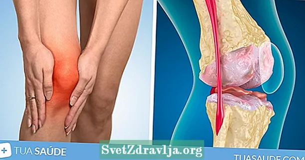 Si të identifikoni dhe trajtoni artrozën e gjurit - Durim