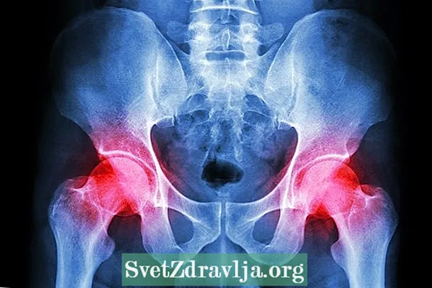 Nzira yekuziva uye kubata polymyalgia rheumatica