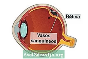 Yuav kho cov retinopathy ntawm lub cev ua ntej li cas