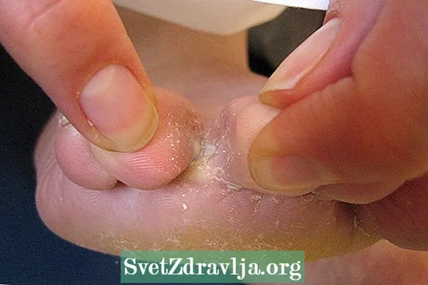 Kako dobiti lišaj na koži, noktima ili vlasištu