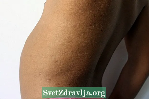 Como conseguir manchas de varicela na túa pel