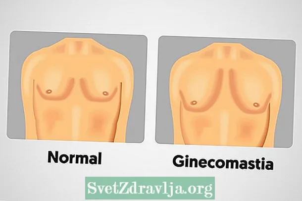 Momwe mungathandizire gynecomastia (male breast augmentation) - Thanzi