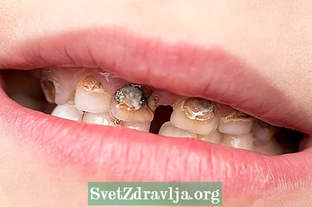 Kuidas ravida hambaemaili hüpoplaasiat