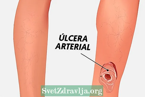 Cómo tratar una úlcera arterial