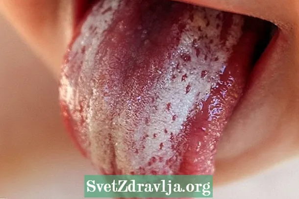 Hur man använder "nystatingel" för att behandla trast i munnen