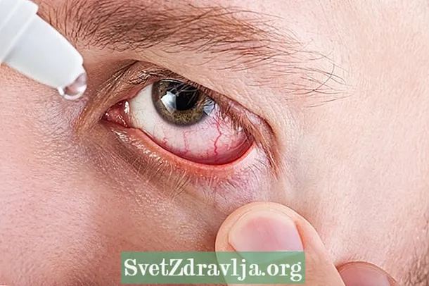 Allergik konjonktivit: nədir, simptomlar və ən yaxşı göz damlaları