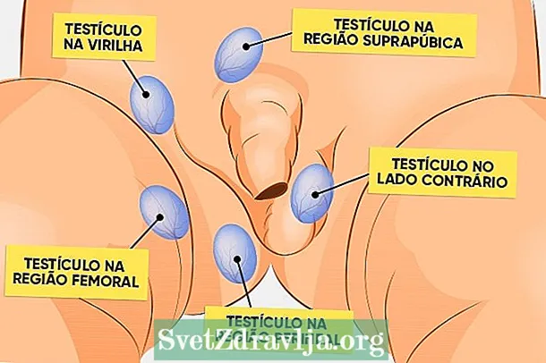 Cryptorchidism - Kana testicle isina kuburuka