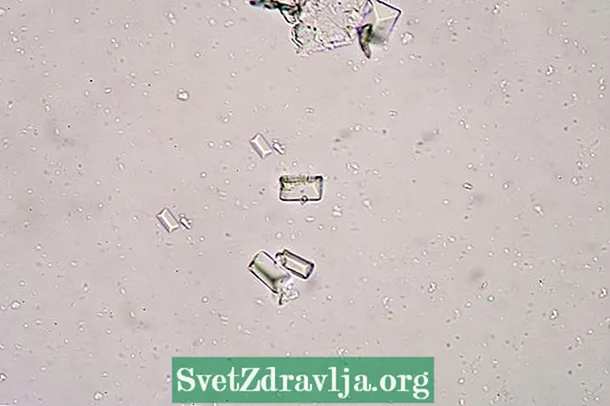 Kristaller i urinpositiva: vad det betyder och huvudtyper