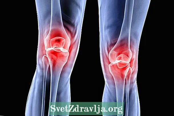 Болката пред коляното може да бъде хондромалация