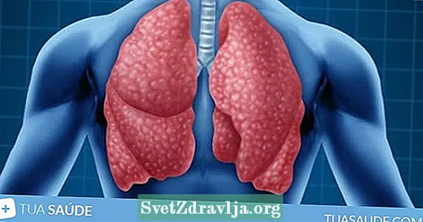 Bol u plućima: 6 glavnih uzroka i što učiniti