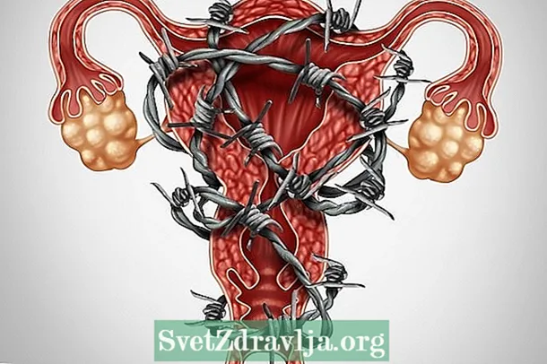 Endometriosis: x'inhu, kawżi, sintomi ewlenin u dubji komuni - Saħħa