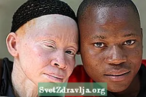 Comprendre millor què és l’albinisme