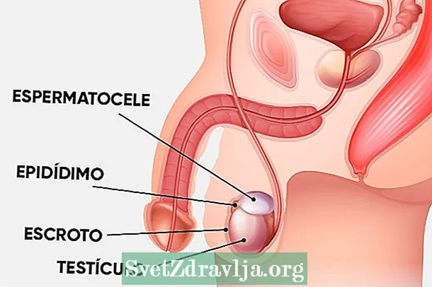 Spermatocele: wat et ass, Symptomer a Behandlung - Fitness