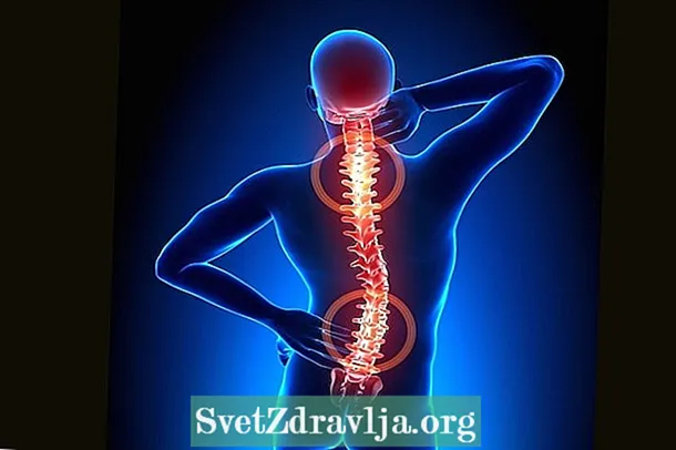 Spondyloarthrosis: çi ye, nîşan û dermankirin